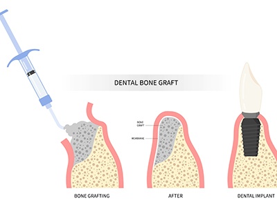 Illustration showing results of dental bone graft