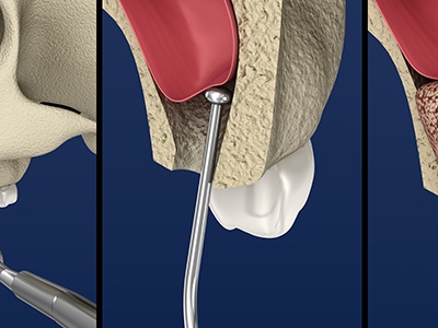 3-part illustration of sinus lift procedure