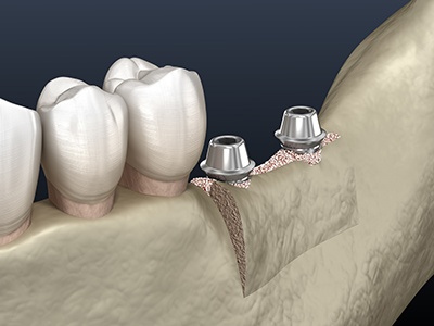 Illustration showing dental implants in bone after ridge expansion