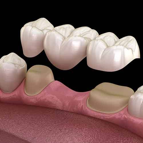 3D render of a dental bridge