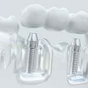 Model of implant dentures