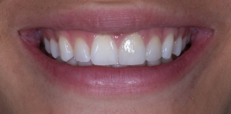 Close up of restored smile with a dental crown