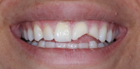 Close up of smile before receiving a dental crown
