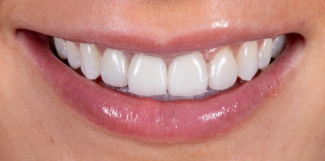 Close up of restored smile with a dental crown