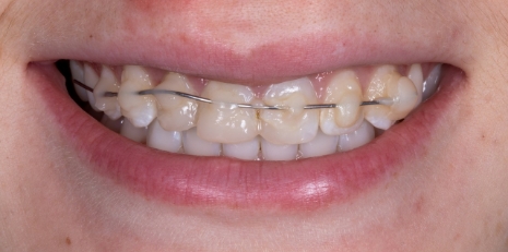 Close up of smile before receiving a dental crown