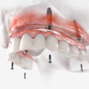 Illustration of fixed implant dentures for upper dental arch