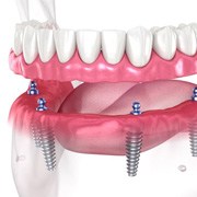 Illustration of removable implant dentures with ball-shaped attachments