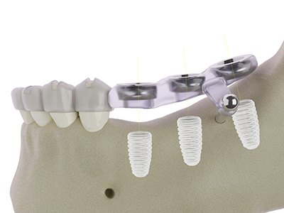 Digital image showing dental implant surgical guide