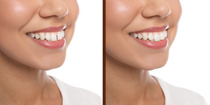 Woman’s smile before and after having gap between teeth fixed